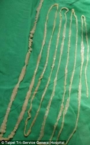 sán dài 3 m trong ruột ảnh 1 san dai 3 m trong ruot anh 1