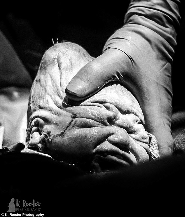 hộp sọ bé sơ sinh bị méo ảnh 1 hop so be so sinh bi meo anh 1