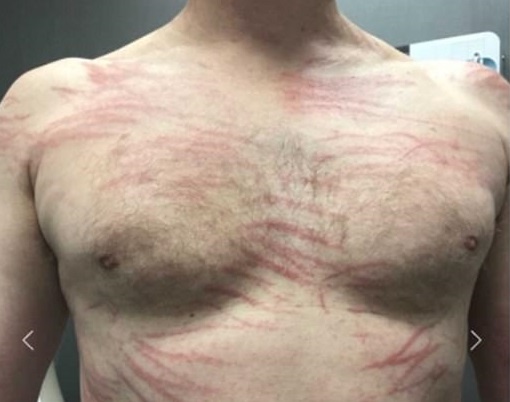 Phat ban khap co the sau khi an nam huong hinh anh