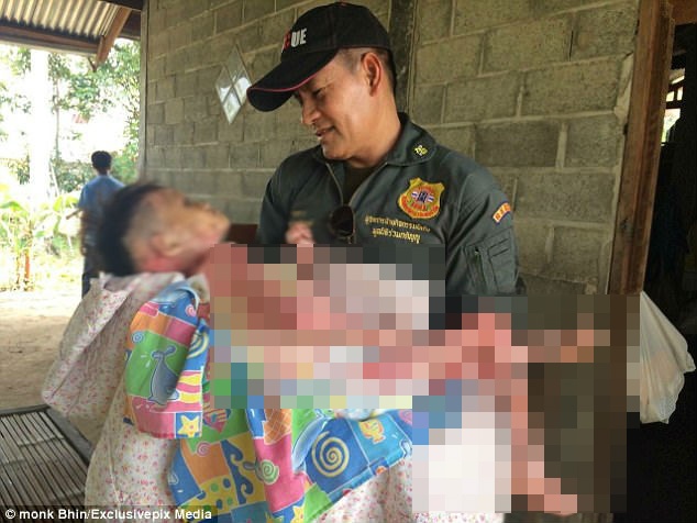 bệnh ly thượng bì bóng nước ảnh 1 benh ly thuong bi bong nuoc anh 1