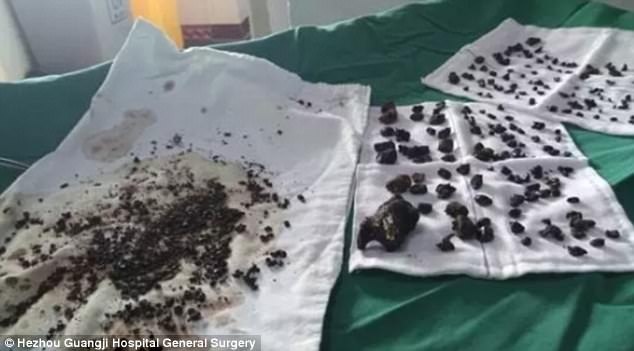 Phẫu thuật loại bỏ 200 viên sỏi mật ảnh 1 Phau thuat loai bo 200 vien soi mat anh 1