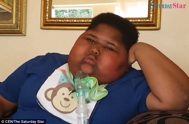 Cau be 10 tuoi nang 90 kg vi khong the ngung an hinh anh