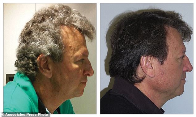 Bac si bat ngo vi benh nhan ung thu khong bi rung toc khi hoa tri hinh anh