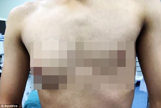 Chang trai mac benh la khien nguc phat trien nhu phu nu hinh anh