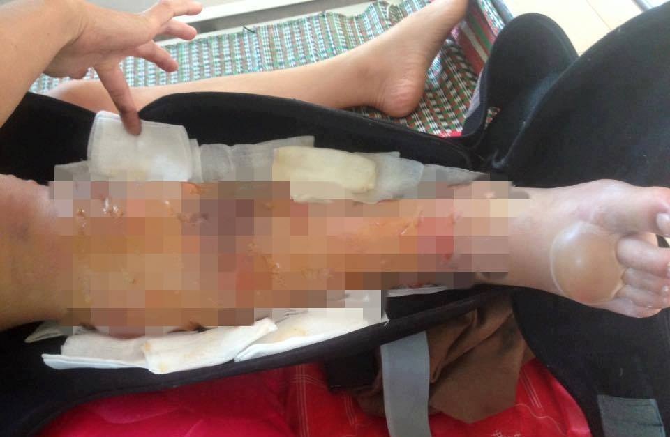 thiếu nữ cưa chân vì bệnh viện tắc trách ảnh 1 thieu nu cua chan vi benh vien tac trach anh 1