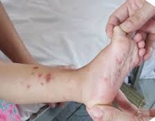 Chau be tu vong do benh tay chan mieng o Dak Lak hinh anh
