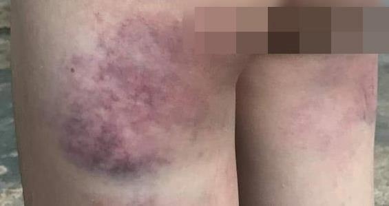 Nữ sinh bị giáo viên đánh ảnh 1 Nu sinh bi giao vien danh anh 1