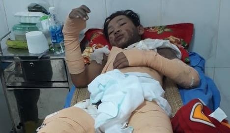 Thieu nien 15 tuoi bi dien giat gay bong nang hinh anh