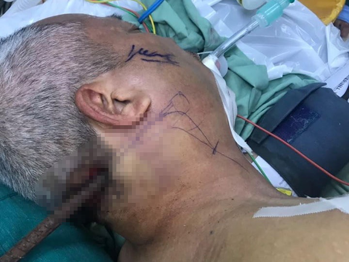 Cuu song nguoi dan ong bi thanh sat gam vao dau hinh anh