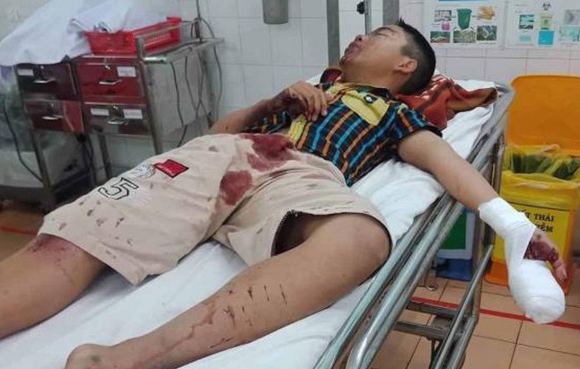 Phao tu che phat no tren tay thieu nien 14 tuoi hinh anh