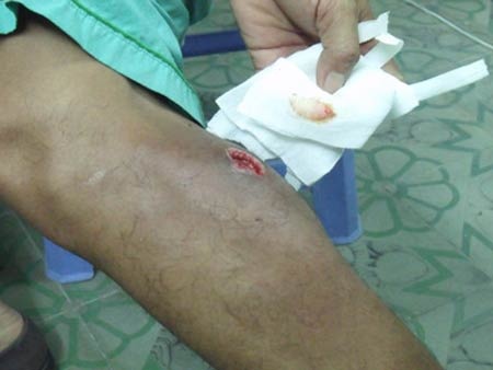 Suyt mat chan vi cuc mau dong bit mach hinh anh