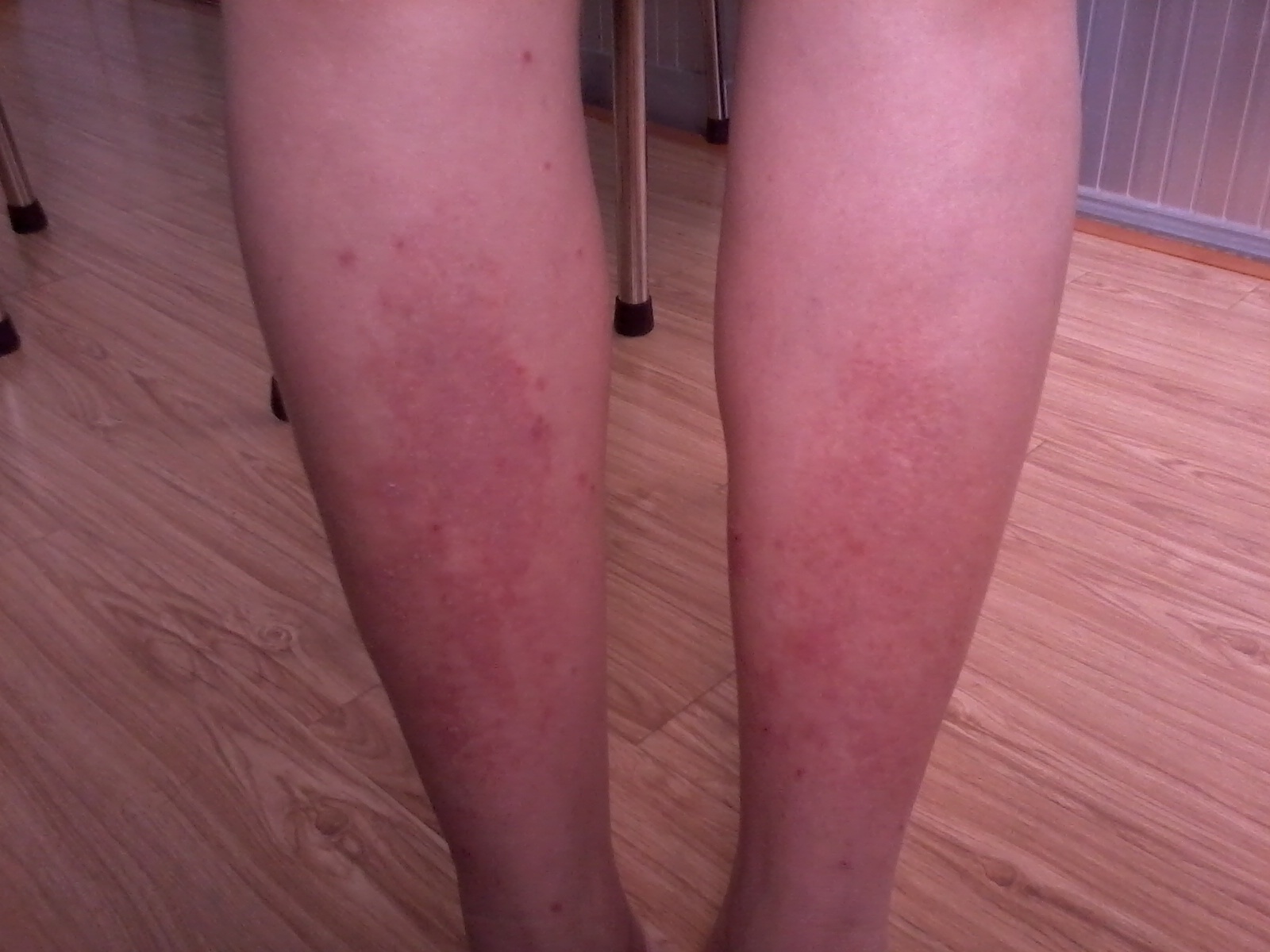 Tổn thương da do giun đũa chó