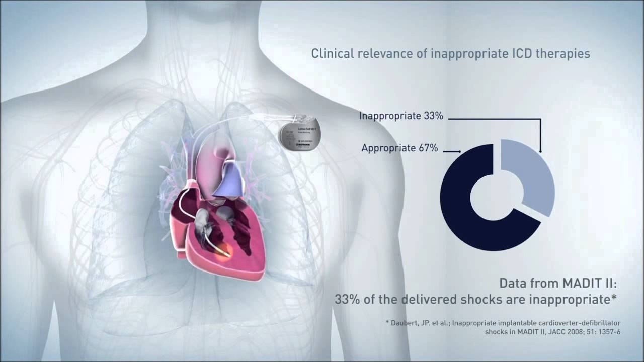 Mô phỏng sự hoạt động của máy rung khử tim khi lắp vào cơ thể bệnh nhân. Hình minh họa
