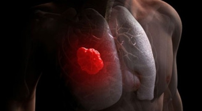 Nguyen nhan gay ung thu phoi hinh anh