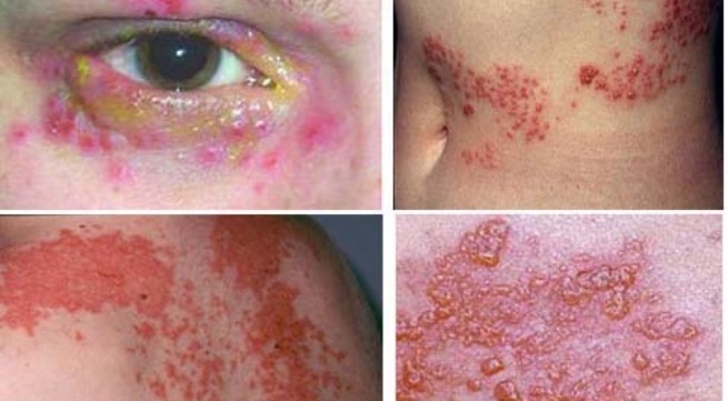 Cach nao dieu tri zona dut diem? hinh anh