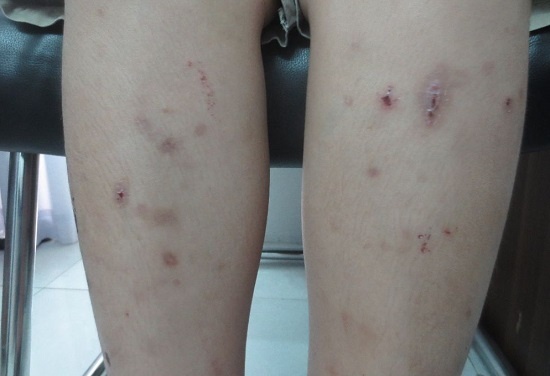 Trieu chung nhiem giun san it ngo nhat hinh anh