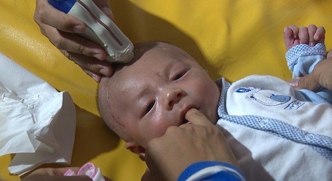 O vi trung trong nao be bi dam xuyen so nguy hiem ra sao? hinh anh