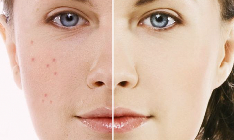 9 bai thuoc dong y tri mun hieu qua hinh anh