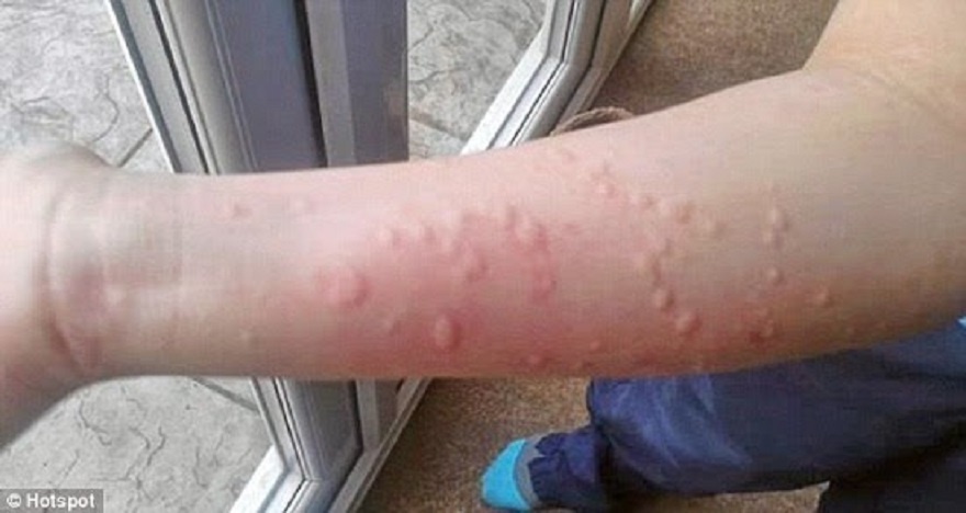 Doi pho can benh gay ngua khi troi lanh hinh anh