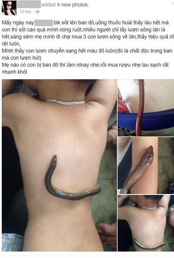 hạ sốt bằng lươn,  sốt phát ban,  hạ sốt,  trẻ sốt ảnh 1 ha sot bang luon,  sot phat ban,  ha sot,  tre sot anh 1