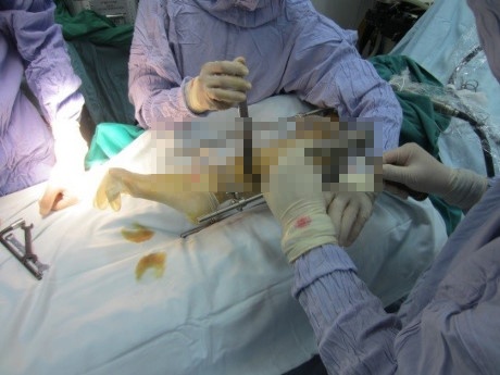 8X chia se ca phau thuat giup tang 7 cm chieu cao hinh anh
