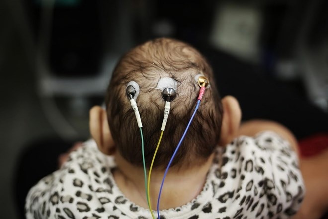 cap sinh doi nhiem virus zika anh 5