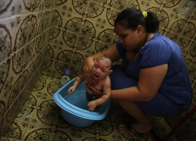 cap sinh doi nhiem virus zika anh 7