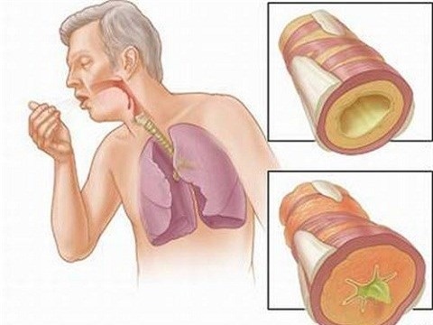 người có nguy cơ mắc ung thư phổi ảnh 1 nguoi co nguy co mac ung thu phoi anh 1