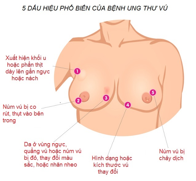 tự khám ung thư vú ảnh 1 tu kham ung thu vu anh 1