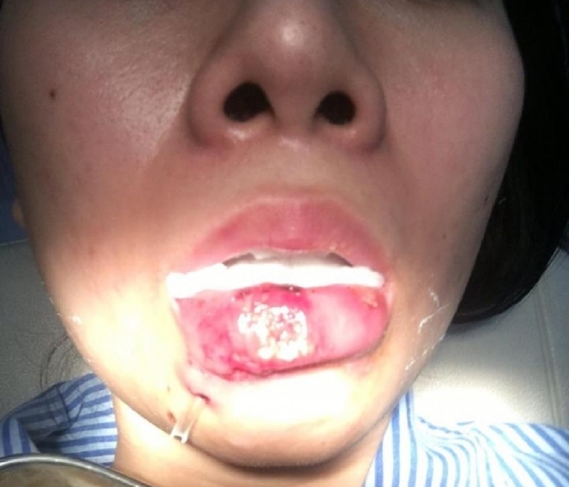 Nu sinh co nguy co cat toan bo moi duoi vi tiem filler chui hinh anh