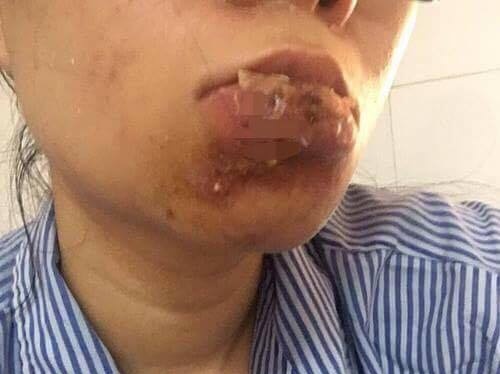 cắt toàn bộ môi dưới vì tiêm filler chui ảnh 1 cat toan bo moi duoi vi tiem filler chui anh 1