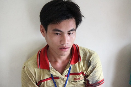 hai em be song sinh bi dinh lien anh 2