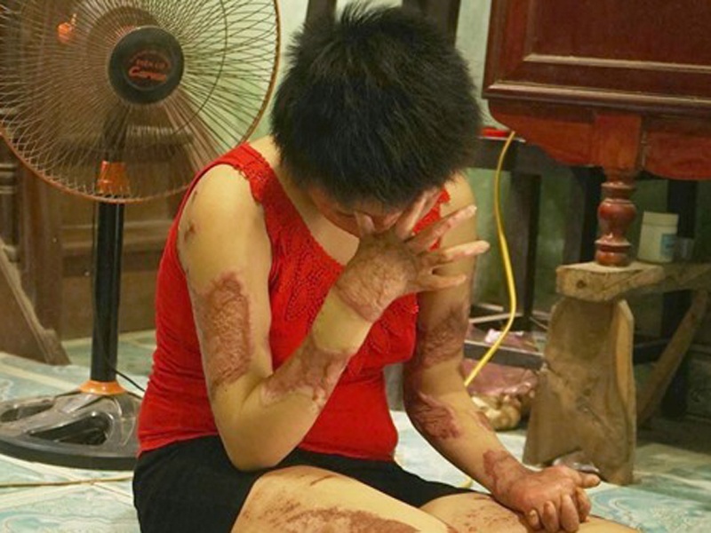 Co gai bi chong tuoi xang dot co the phuc hoi guong mat hinh anh