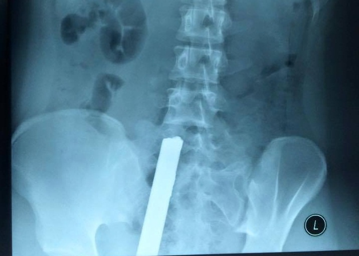 Thanh sat tu xe ba gac dam xuyen nguoi nu sinh 16 tuoi hinh anh