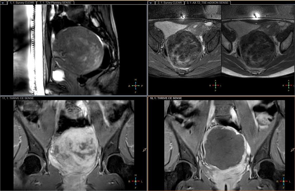 Nguoi phu nu de khoi u chiem toan bo tu cung anh 1