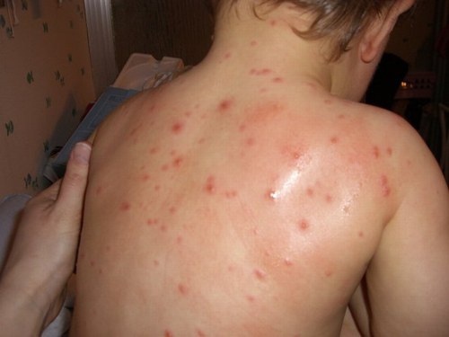 Con moc mun khap nguoi vi me tu mua thuoc chua benh hen hinh anh