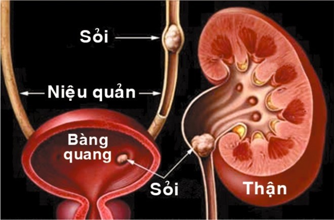 bệnh sỏi thận ảnh 1 benh soi than anh 1
