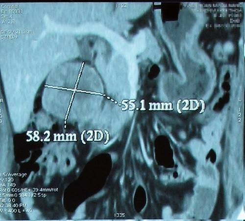 Nữ 9X mắc ung thư thận ảnh 1 Nu 9X mac ung thu than anh 1