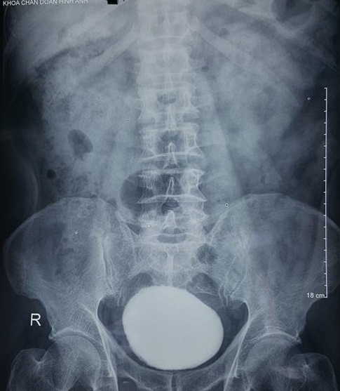 soi nang nua can trong bang quang anh 1