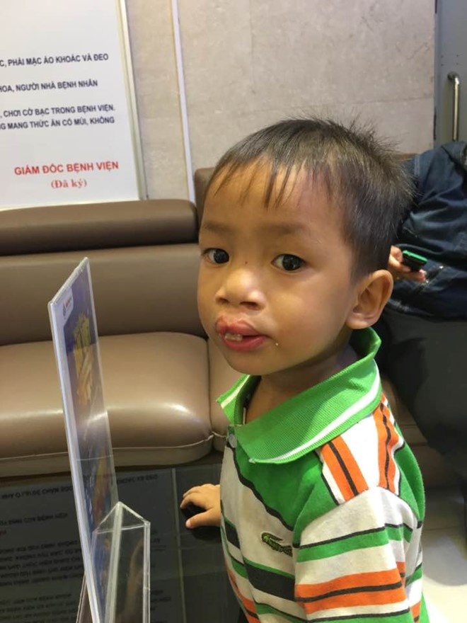 phẫu thuật hở hàm ếch miễn phí ảnh 1 phau thuat ho ham ech mien phi anh 1