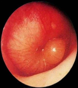 xì mũi sai cách ảnh 1 xi mui sai cach anh 1