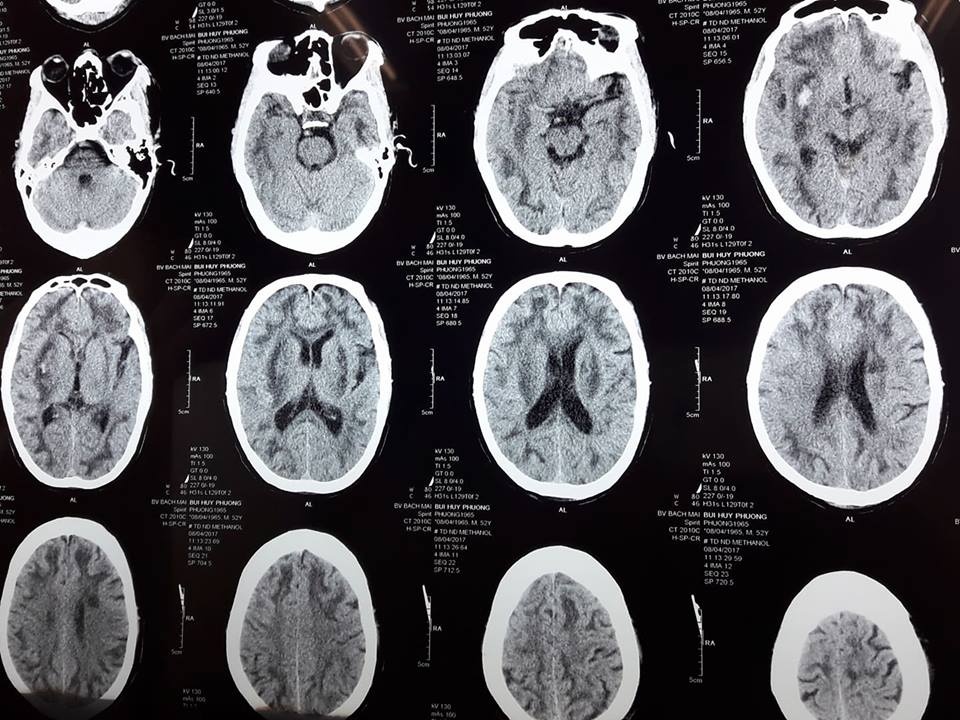 2 người nguy kịch do ngộ độc rượu methanol ảnh 1 2 nguoi nguy kich do ngo doc ruou methanol anh 1