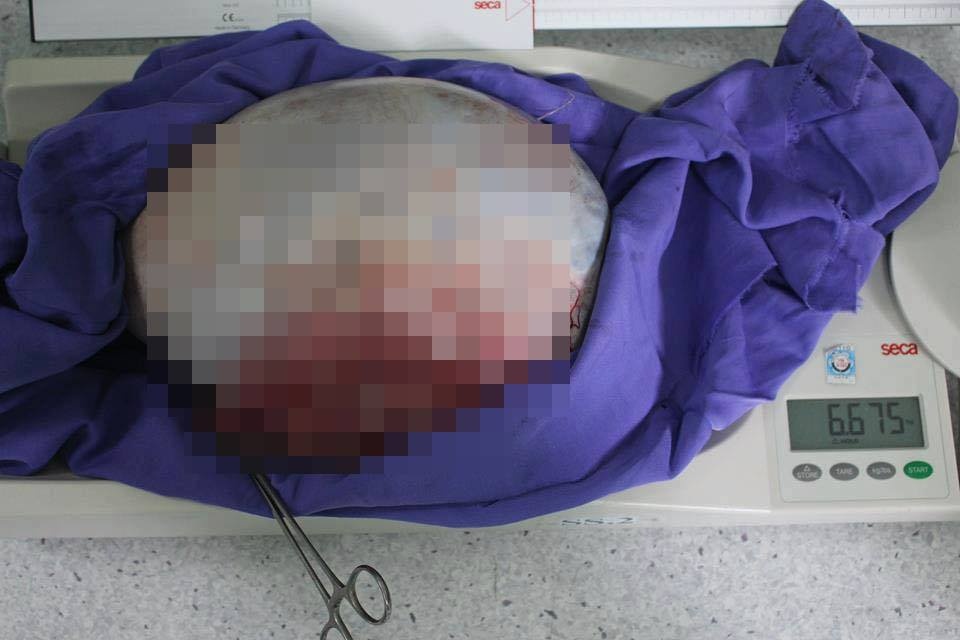 khối u nang buồng trứng gần 7 kg  ảnh 1 khoi u nang buong trung gan 7 kg anh 1