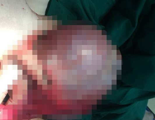 Co gai mang u nhay gan 2 kg nhung tuong beo bung hinh anh