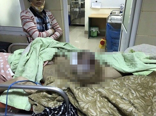 cat bo chan vi ung thu xuong anh 1