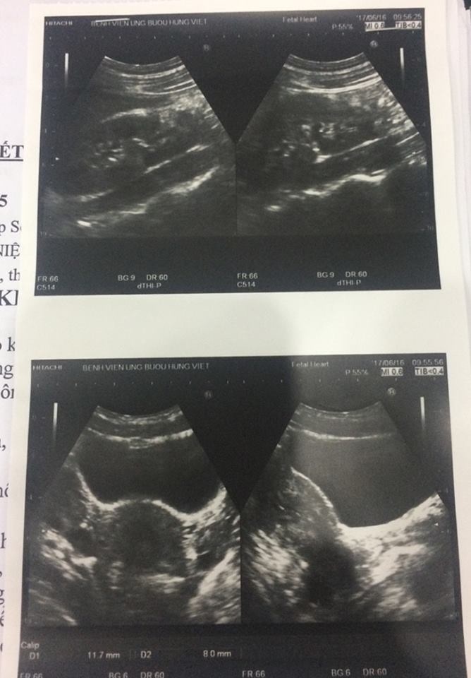 co gai co 3 qua than,  3 nieu quan anh 1