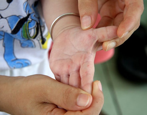 Sai lam cua cha me khien tre mac tay chan mieng hinh anh