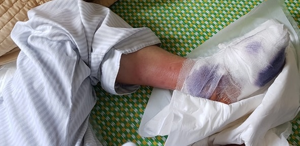 Noi am anh cua benh nhan tieu duong khi phai cat chan hinh anh