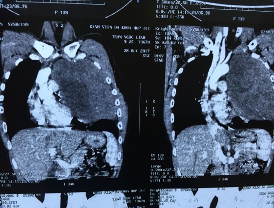 9X phat hien khoi u nang 3 kg anh 1