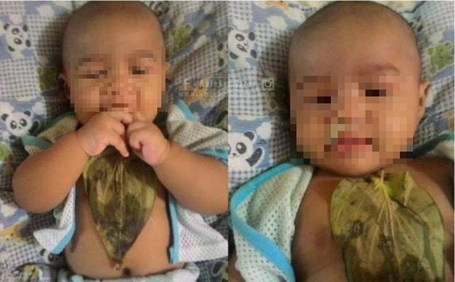 Dap la chua so mui, be 6 thang tuoi bi bong sau do IV hinh anh